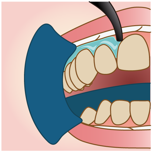歯ぐきの保護＆薬剤塗布