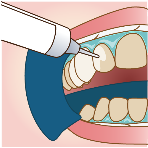 歯ぐきの保護剤除去